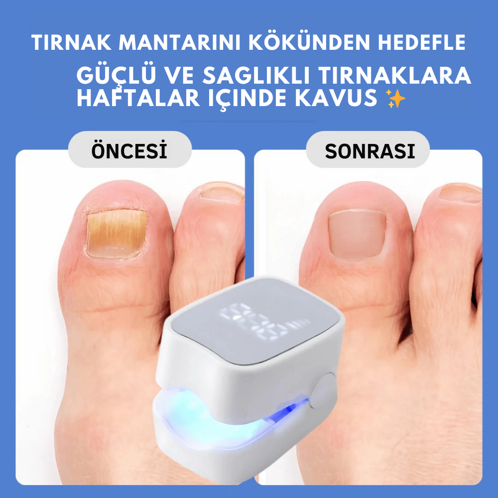 Ortopedya ClearNail™ (Tırnak Mantarını Kökten Yok Eden Işık Terapisi)