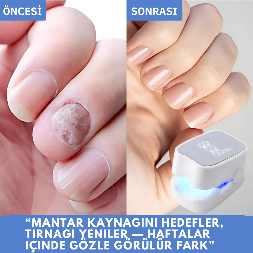 Ortopedya ClearNail™ (Tırnak Mantarını Kökten Yok Eden Işık Terapisi)