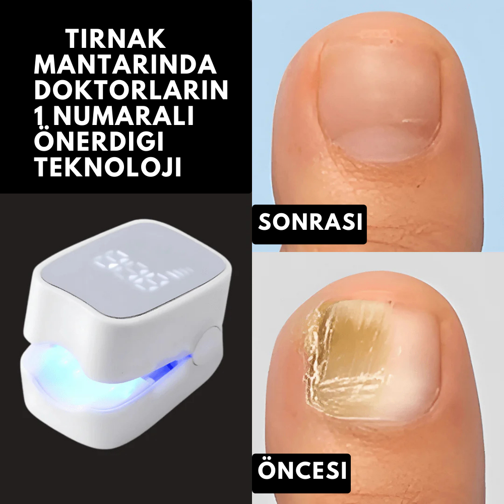 Ortopedya ClearNail™ (Tırnak Mantarını Kökten Yok Eden Işık Terapisi)