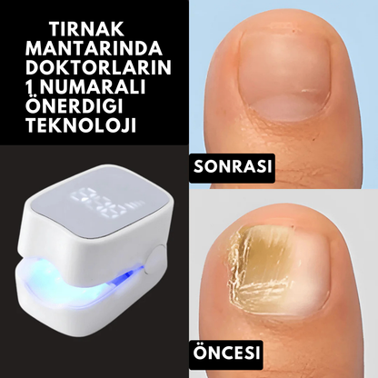Ortopedya ClearNail™ (Tırnak Mantarını Kökten Yok Eden Işık Terapisi)