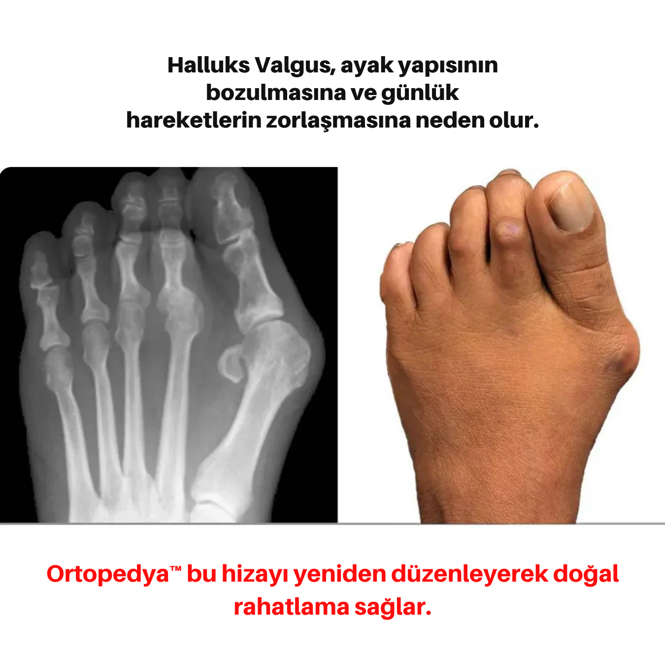 OrtoPedya Başparmak Düzeltici