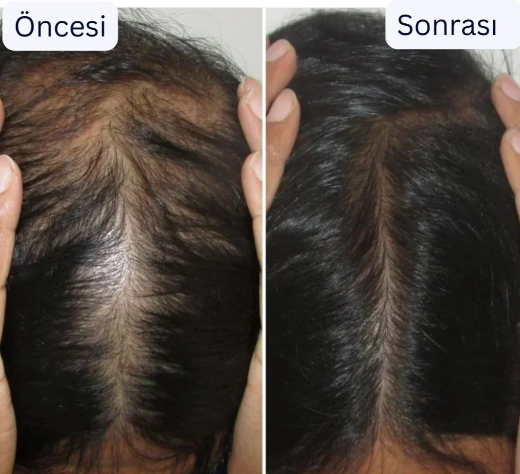 Ortopedya™ Saç Derisi Masaj aleti